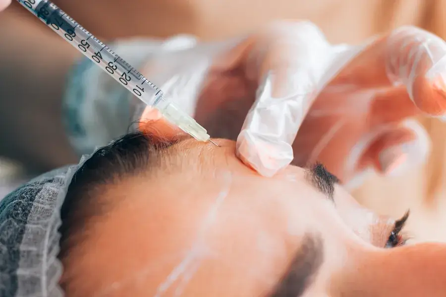 A wrinkle-relaxer injection smoothing horizontal forehead lines at a Thonotosassa, FL medical spa