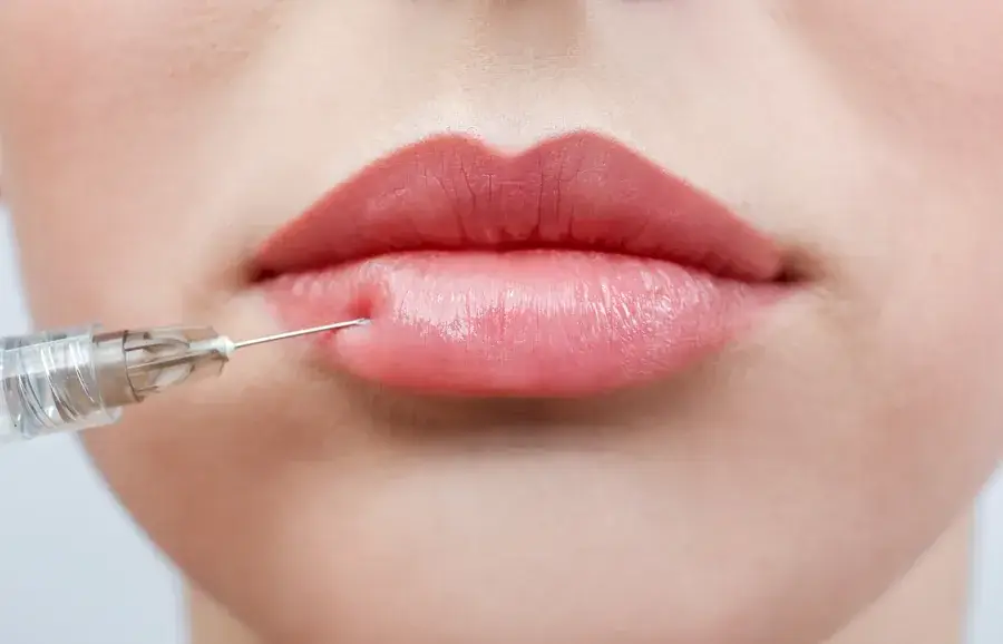 A close-up lip-area injection for a lip flip at a Thonotosassa, FL medical spa