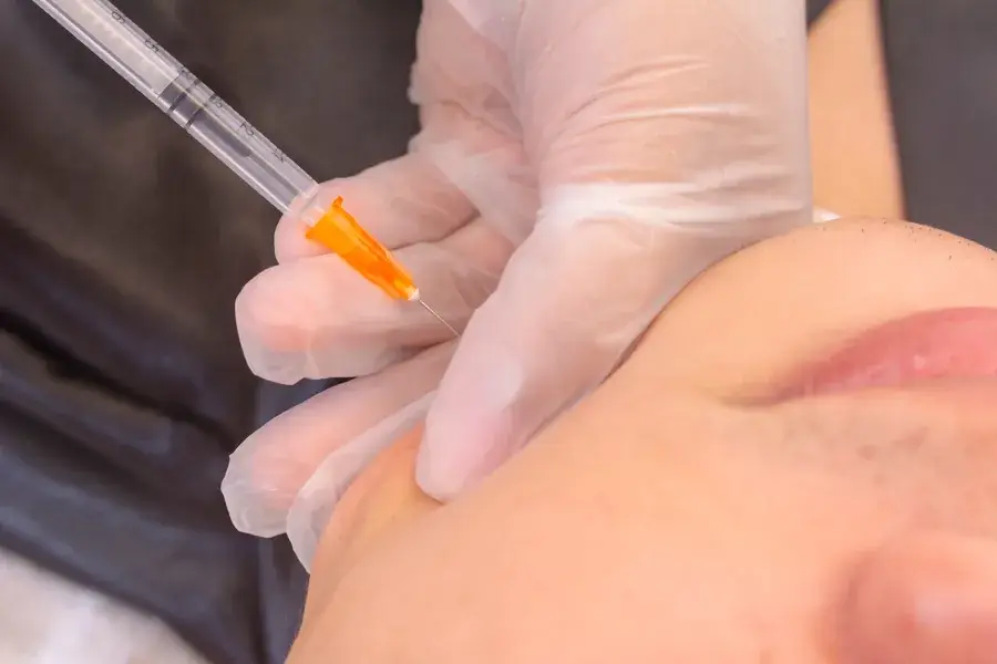 A masseter and jawline wrinkle-relaxer injection for facial slimming at SpaRx Medical Aesthetics in Thonotosassa, FL